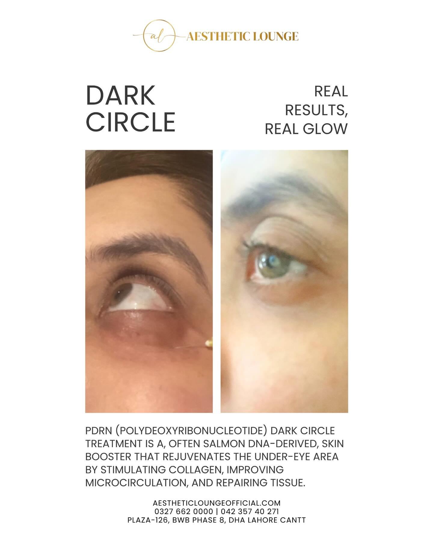 Dark Circle Treatment — real client result at Aesthetic Lounge, DHA Lahore