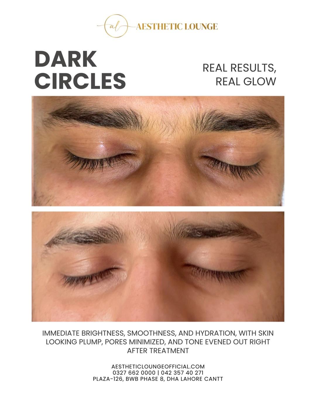 Under-Eye Rejuvenation — real client result at Aesthetic Lounge, DHA Lahore
