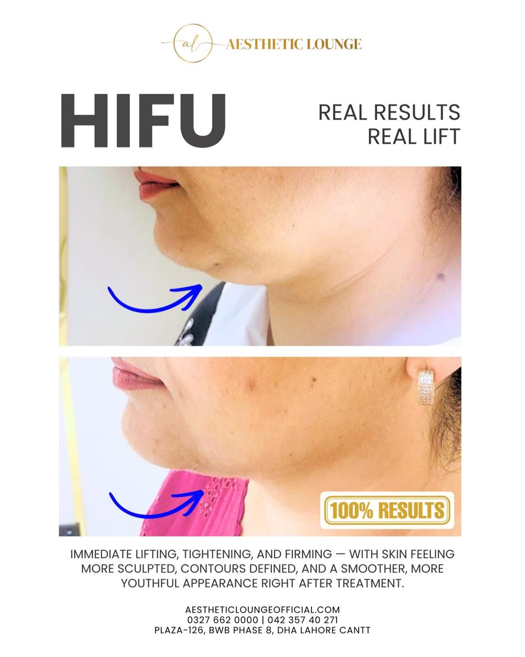 HIFU — Jawline Definition — real client result at Aesthetic Lounge, DHA Lahore
